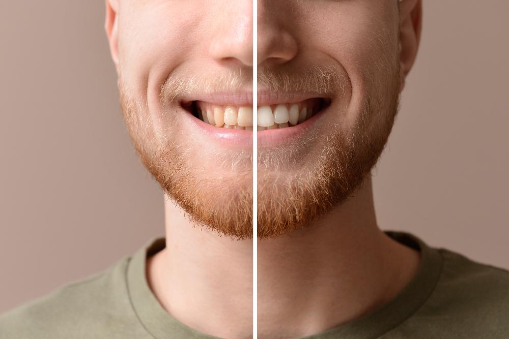 before and after teeth whitening | teeth whitening southampton ny