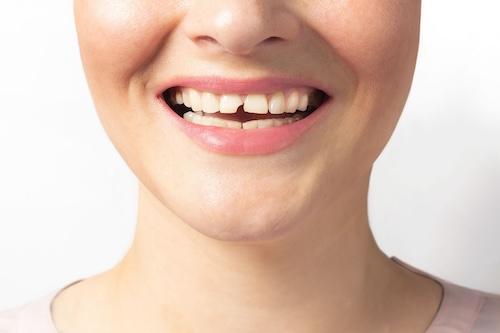 patient with chipped tooth | emergency dentist southampton