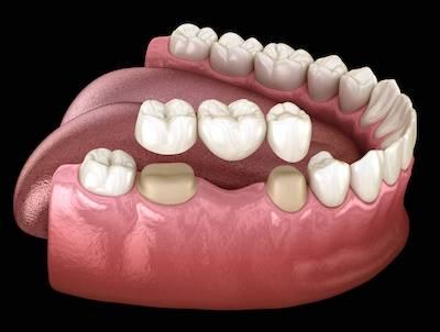 close up of dental bridge in jaw | dental crown southampton ny
