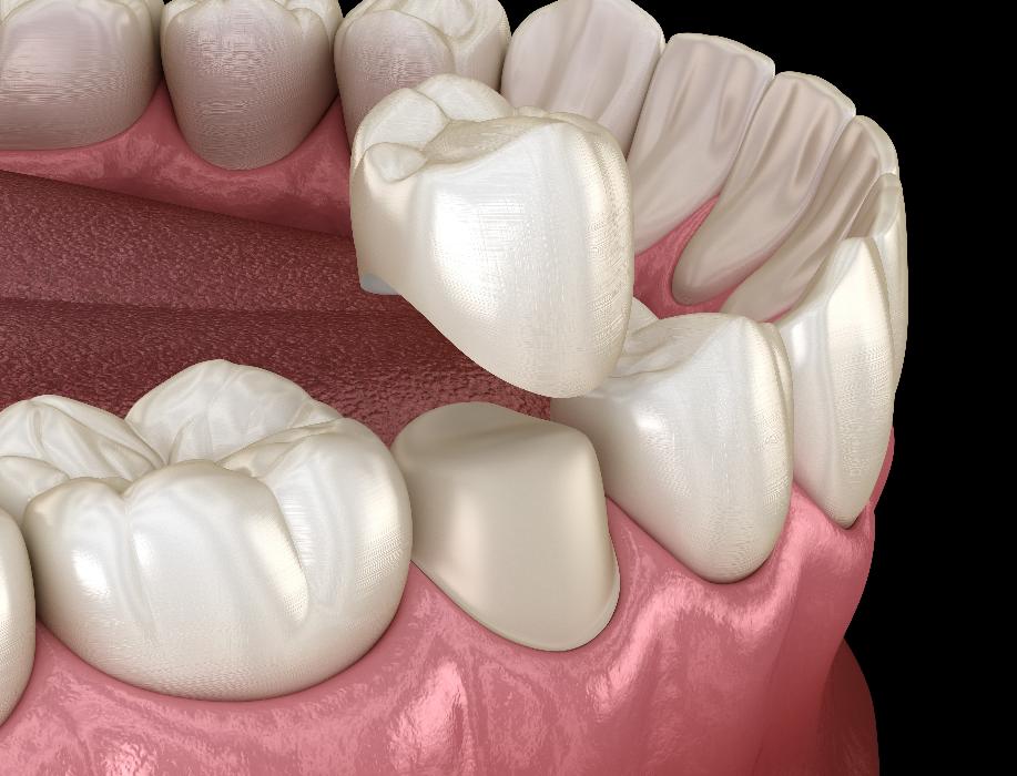 dental crown being put on tooth | dental crown southampton ny