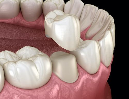 close up of dental crown on tooth | dentist southampton ny