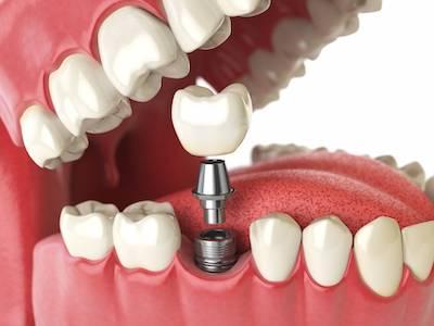 close up of implant in jaw | dental implants southampton ny
