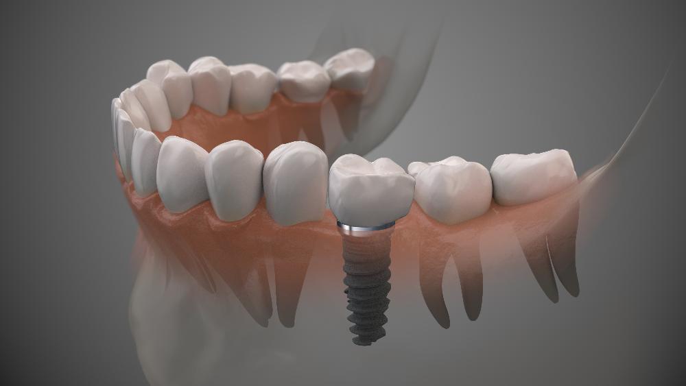 rendering of single tooth implant in jaw | dental implants southampton ny