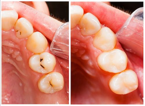 close up of tooth bonding | cosmetic dentist southampton