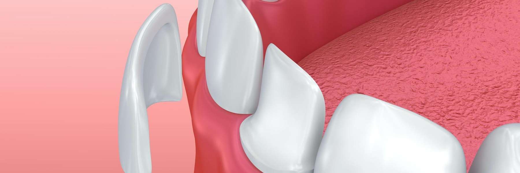 Dental veneers in Southampton NY