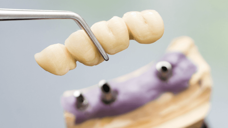 dentist in south hampton holding dental bridges
