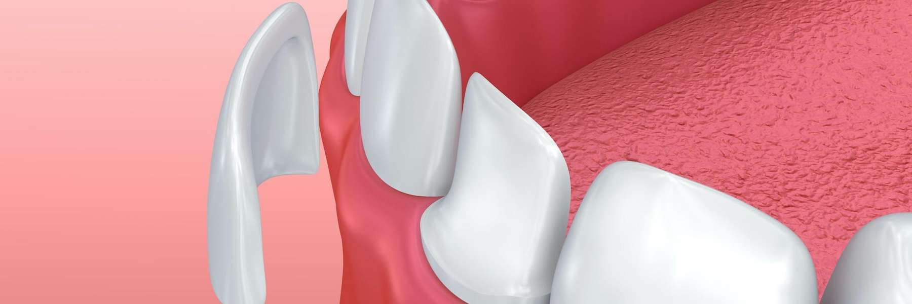 Porcelain veneers on lower front teeth in Southampton NY