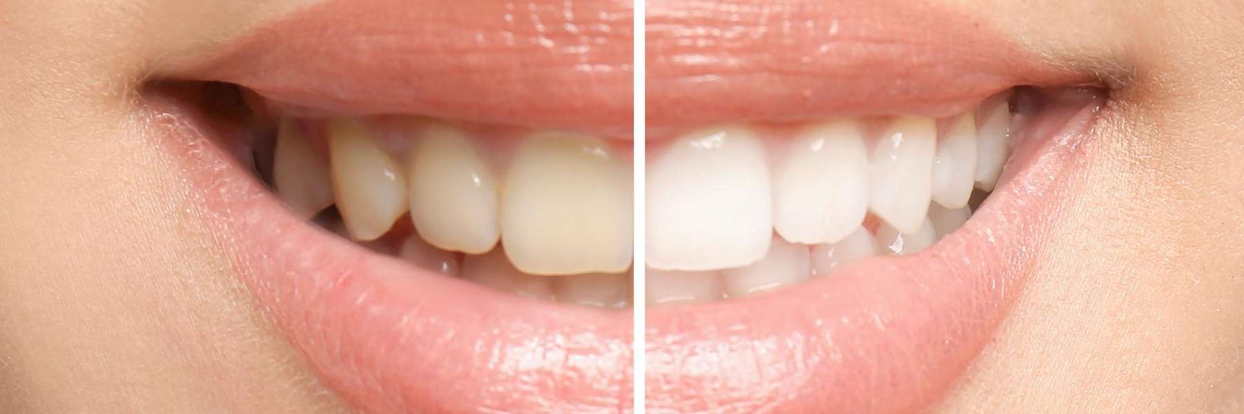 before and after of teeth whitening | southampton dentist