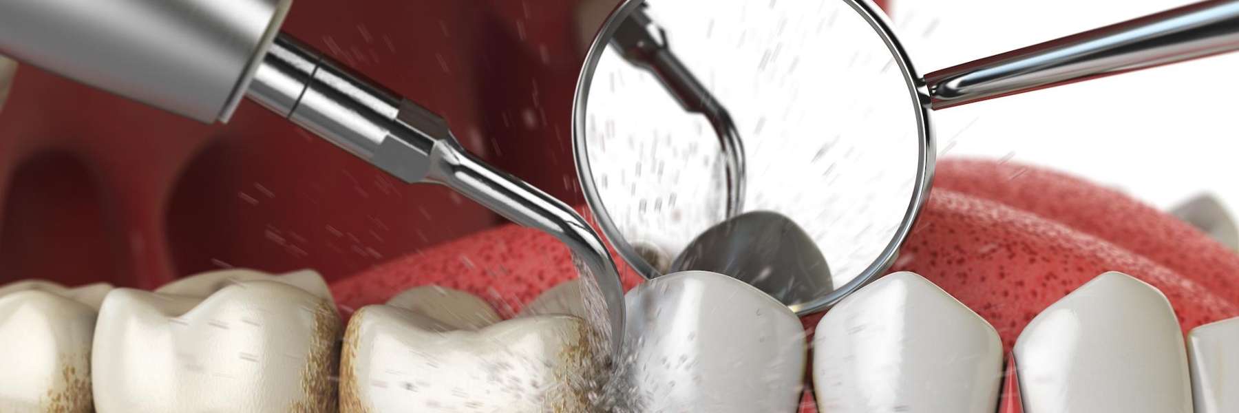 dental cleaning of teeth with tartar in Southampton NY